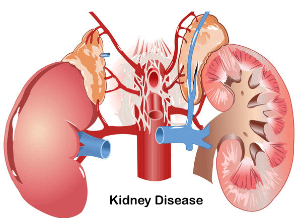 6-Kidney-Disease